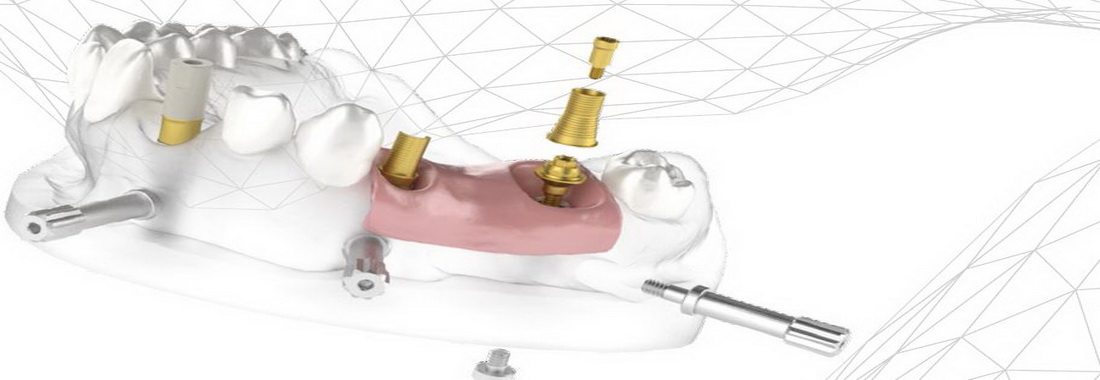 01-model-3D-digitalni-tisk-exklusiv-dent